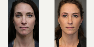 Maintenance Filler, Microneedling, Neuromodulator - Use of sculptra, platelet rich plasma with microneedling and Botox to maintain volume and facial skin quality.