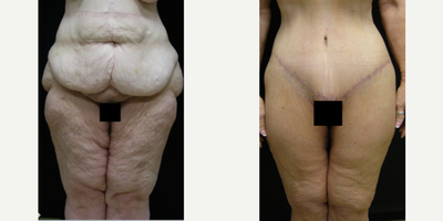 35-44 year old woman treated with Thigh Lift - 43 year old female treated with thigh lift.