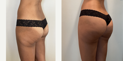 35-44 year old woman treated with truSculpt flex - 44 year old patient before and after 4 sessions of trusculpt flex to the abs and glutes.