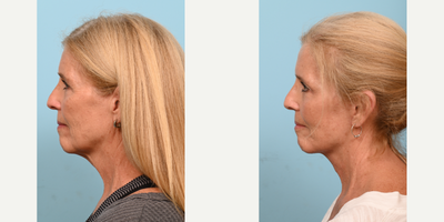 55-64 year old woman treated with Deep Plane Facelift - This 60-year-old patient was bothered by the excess skin outside of the edge of her eyelid. The doctor preformed a facelift with a temporal browlift and upper blepharoplasty.
