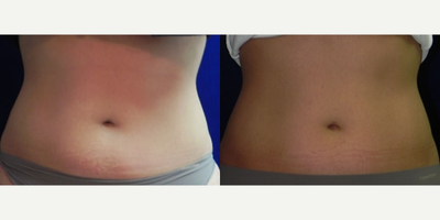 Woman treated with Vanquish - Woman treated with Vanquish.