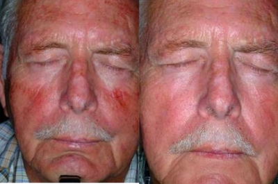 PDT for rosacea - 
	Patient before and after PDT treatment for rosacea.
