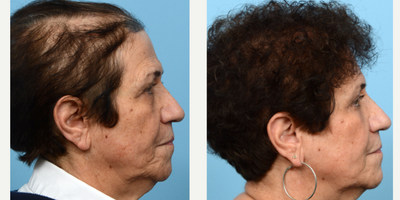 65-74 year old woman treated with Low-Level Laser Therapy - This 71-year-old patient was experiencing a lot of hair loss in addition to thinning on the sides and crown. To fill in these areas and add density overall, Dr. Wise performed an FUT hair transplant using 2,030 grafts, during which she also underwent one session of PRP.