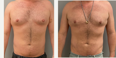 35-44 year old man treated with Liposuction, SAFELipo, Tumescent Liposuction - 39 yo s/p abdominal liposuction performed under sedation in our on site AAAA certified operating suite