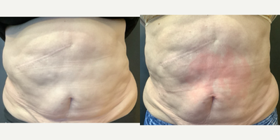 75 and up year old woman treated with Emsculpt - Emsculpt Neo 4 sessions. patients main concern to correct posture, balance and core strength.