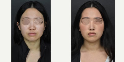 25-34 year old woman treated with Asian Rhinoplasty, Rhinoplasty - Patient got a beautiful tip with rib rhinoplasty.