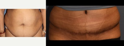 Woman treated with Tummy Tuck - Woman treated with Tummy Tuck