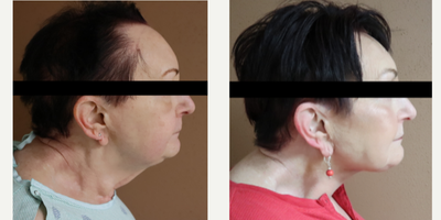 65-74 year old woman treated with Neck Lift - This is a 74 year old female who was tired of her excess fat and skin of her neck area. This is a 3 week post op result, and we are expecting an even better result as swelling subsides.