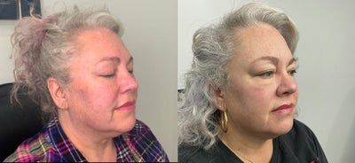 45-54 year old woman treated with AccuTite - This Calgary woman came into our clinic in Mission and had concerns about her submental fat and skin underneath her chin and jawline. She wanted to refresh her look with the help of AccuTite/FaceTite and our team helped her achieve that! Look at this incredible before and after!