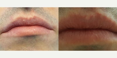 34 year old man treated by Plasma Coagulation with Fordyce Cyst Removal from upper lip in two sessions - Fordyce cysts can be rebomeved from lips and genitals in one or two sessions by Plasma coagulation. This procedure has rapid healing and leaves no scar.