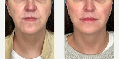 45-54 year old woman treated with Dermal Fillers, Cheek Fillers, Lip Fillers, Liquid Facelift, Radiesse, Restylane Lyft, RHA Col - Volume loss is common in all ages. The object is to replace lost volume and thereby rejuvenate the face, jawline and neck. Using a variety of techniques these areas are supported and smoothed out. The end result is a natural appearing rejuvenation. When combined with the Endolift Laser and PDO Threads the results are even more outstanding.