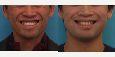 25-34 year old man treated with Jaw Reduction - Chief Complaint: Too much gum showingDiagnosis: Maxillary vertical excess growth Treatment: Lefort I ostetomy