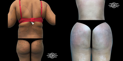 35-44 year old woman treated with Brazilian Butt Lift - BBL