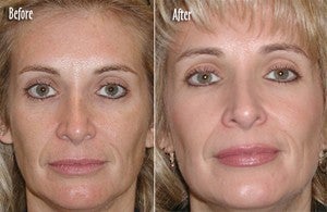  Microdermabrasion Full Face - 