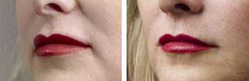 Collagen injection for mouth lines - 