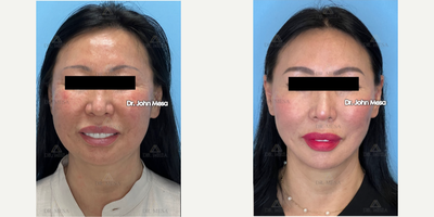 45-54 year old woman treated with Buccal Fat Removal, Chin Liposuction, FaceTite, AccuTite, NeckTite, Morpheus8 - 45-54 year old woman treated with Buccal Fat Removal 90% , Extended Chin Liposuction, FaceTite, AccuTite, NeckTite, Morpheus8