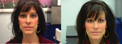 Cheek augmentation and cheek enhancement - Voluma was injected into the cheeks of this forty something thin young looking mom. The Voluma before and after photo were taken within minutes of each other.&nbsp;