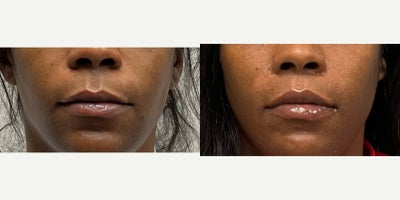 35-44 year old woman treated with Lip Lift, Lip Surgery - this young woman underwent a lip lift with augmentation.