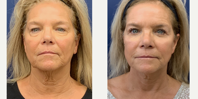 65-74 year old woman treated with Facelift, Double Eyelid Surgery - 84092