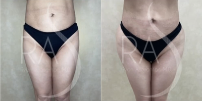 Woman treated with Butt Implants - Woman treated with Butt Implants