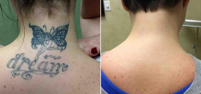 25-34 year old woman treated with Tattoo Removal - Full removal in only 6 treatments of large tattoo of a fairy and the words, dream using the PicoSure laser.