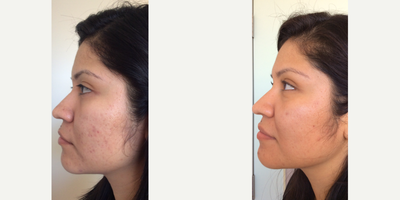 Fraxel Acne Scar Treatment - The patient was concerned with her post-acne marks. Fortunately, the Fraxel Laser is perfect for getting rid of acne scarring. However, it isn't just for acne scars! In fact, you will see improvements in the appearance of hyerpigmentation and the general texture of your skin.