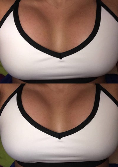 36F to *hopefully* 36C - Chelmsford, MA - Review - RealSelf