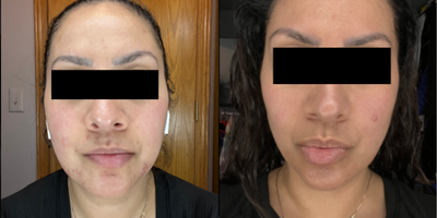 35-44 year old woman treated with Accutane - Acne Treatment