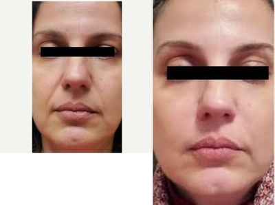 35-44 year old woman treated with Juvederm - Before and after Botox to forehead and between eyebrows. Juvederm to folds beneath the nose and above the lips --