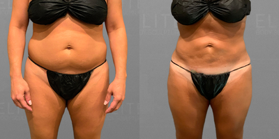 55-64 year old woman treated with AirSculpt - Not only does AirSculpt on the back bra rolls help reduce fat along the bra line, but it also provides instant relief to an area that often causes women discomfort. This patient received a back bra roll and full abdominal treatment just three months ago and already has significant changes to show!