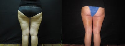 Cellulaze - Cellulite Treatment - 
	Pt is 1 week post of for Cellulaze treatment.&nbsp;
