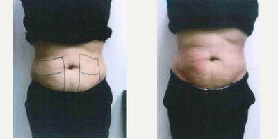 25-34 year old woman treated with Skin Rejuvenation Body Fx & Body Plus - 2 Treatments of Body Fx. fat reduction and Body Plus, skin tightening.