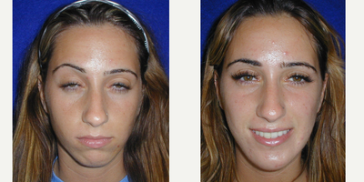 18-24 year old woman treated with Cheek Implants - 23 year old female underwent Chin Implant surgery under local anesthesia.