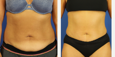 35-44 year old woman treated with Mini Tummy Tuck - Active Patient that had an in-office tummy tuck.