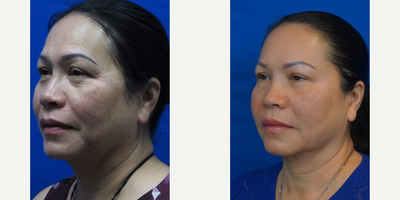 55-64 year old woman treated with Thermage - Looking to Improve her aging, this patient underwent a full face and neck using the 1200 pulse CPT tip.