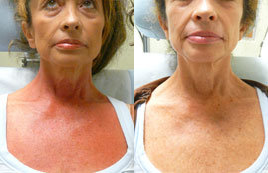 Poikiloderma Treatment with Vbeam - 
	Poikiloderma is refers to the mottling of sun exposed areas of the skin most especially the d&eacute;collet&eacute; chest. It manifests as redness causes by widened capillaries, as well as dark and light spots. There is often a sharp cut off line at the pint where the affected area ends in the neck area. It is believed to be cause by sun damage caused by chronic sun exposure Using the VBeam pulse dye laser which treats in the 585 nm wavelength, the patient improved after only 4 treatments.
