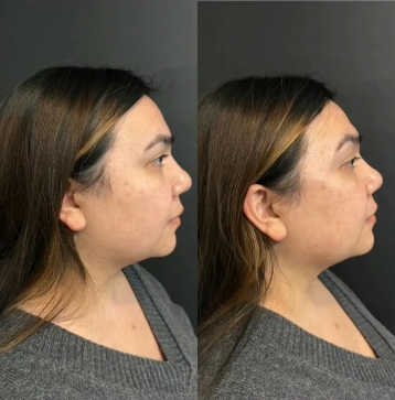 Woman treated with Cheek Lift - Woman treated with Cheek Lift