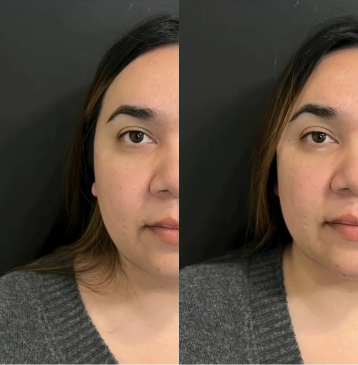 Woman treated with Cheek Lift - Woman treated with Cheek Lift