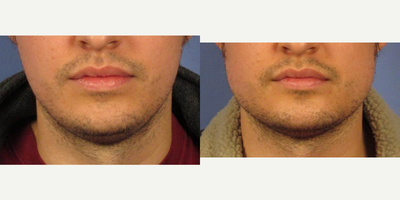 25-34 year old man treated with Chin Implant - This gentleman in his 20s wanted a more masculine jawline. He had jaw implants placed to his chin and the angle of his jaw. Silicone implants were placed through incisions placed in the mouth. Here he is at 2 month follow up.