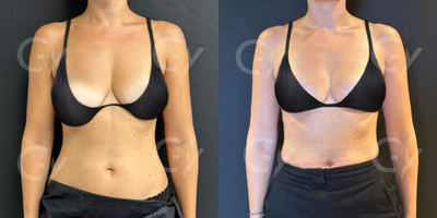 25-34 year old woman treated with Breast Lift - Breast Lift by M.D. Gray Yeiladal
