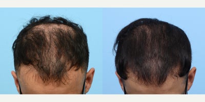 35-44 year old man treated with FUE Hair Transplant, Hair Transplant, Hair Loss Treatment, PRP for Hair Loss, PRP Injections - This patient wanted to restore hair to zones 1,2 and 4 of his scalp. Dr. Wise performed an FUE hair transplant with one session of PRP therapy to achieve this patient's goal.
