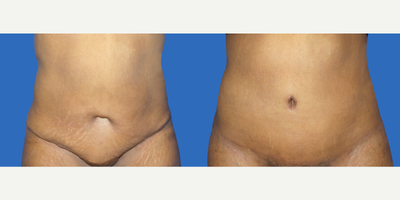 35-44 year old woman treated with Tummy Tuck Revision - This patient is a 42 year old female who consulted with Dr. Greenberg complaining of the excess skin of her abdomen. This patient had had a prior abdominoplasty performed by another surgeon many years ago and had also subsequently had more children. She was concerned with the poor scarring from her previous tummy tuck, wished for better abdominal contour and for treatment of her stretch marks. After a thorough conversation, she elected to have a revision abdominoplasty where Dr. Greenberg addressed the poor scarring, redundant skin of her abdomen, and abdominal wall laxity from her pregnancies. As you can see from her 5 month post-operative photo, she has achieved significantly better abdominal contour and great improvement of her tummy tuck scar and stretch marks.