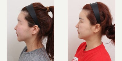 25-34 year old woman treated with AccuLift, Liposuction - 33 Years old female patientChief Complaint:Facial puffiness and uneven contour, especially in the lower cheeks and jawline.Treatment Plan:Facial liposuction focusing on lower cheeks and jawline refinement.Outcome:Slimmer, more defined facial contour with reduced puffiness and improved facial balance.