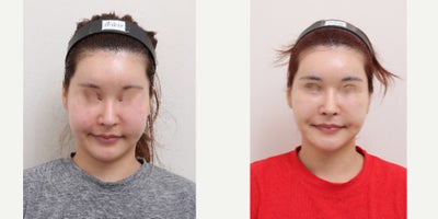 25-34 year old woman treated with AccuLift, Liposuction - 33 Years old female patientChief Complaint:Facial puffiness and uneven contour, especially in the lower cheeks and jawline.Treatment Plan:Facial liposuction focusing on lower cheeks and jawline refinement.Outcome:Slimmer, more defined facial contour with reduced puffiness and improved facial balance.