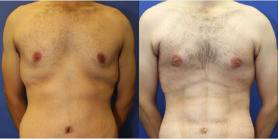 Man treated with VASER Shape - Vaser Hi Def Abs