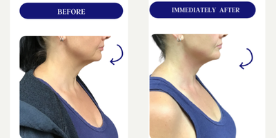 45-54 year old woman treated with Fractora RF, Forma, Facial, Skin Tightening, Skin Rejuvenation - FRACTORA FIRM-FORMAbipolar radiofrequency