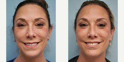 55-64 year old woman treated with Lip Lift - Subnasal lip lift
