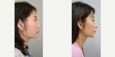 Deep Plane Facelift, Revision Rhinoplasty, Square Jaw Reduction - Deep Plane Facelift, Revision Rhinoplasty (Rib cartilage), Square Jaw Reduction performed by Dr. Myung Ju Lee of VIP Plastic Surgery Korea
