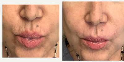65-74 year old woman treated with RHA Collection Fillers - 67 y.o. female - c/o of fine lines above and around mouth (smoker's lines/lipstick lines). Does not want botox in that area due to side effects. Has had lip fillers in past but wants the vertical lines above the lips to be smoothed out. Using RHA1 (Redensity) with a micro-cannula - the wrinkles were carefully placed and the adhesions subcised for a great result with no bruising or swelling. Painless and the patient was very pleased.