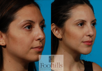 Woman treated with Chin Implant - Woman treated with Chin Implant